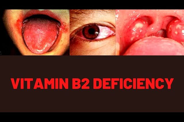 Vitamin B2 Riboflavin Deficency